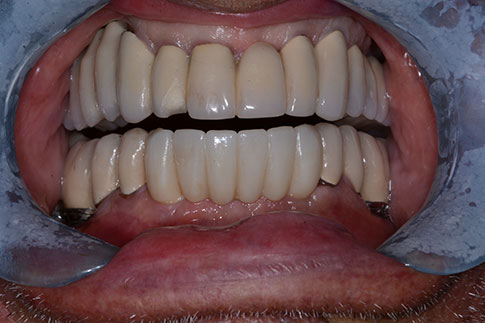 Complete Set of Implant-Supported Teeth, before treatment photo, patient 2
