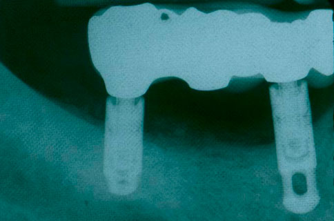Condemned Implant Bridge Preservation Via Implant Decontamination/Bone Reconstruction.