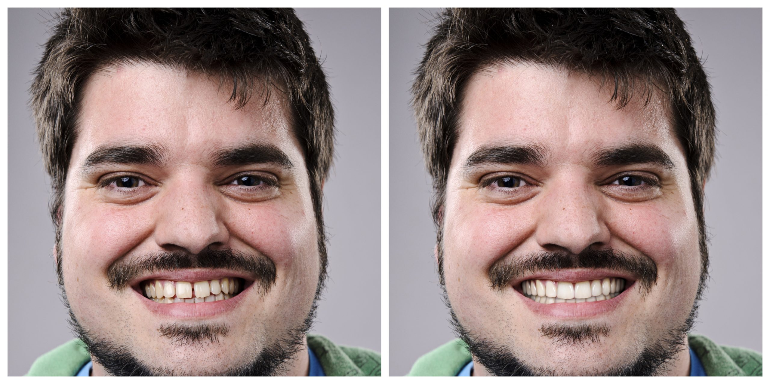 Smile Restoration - Before and After1
