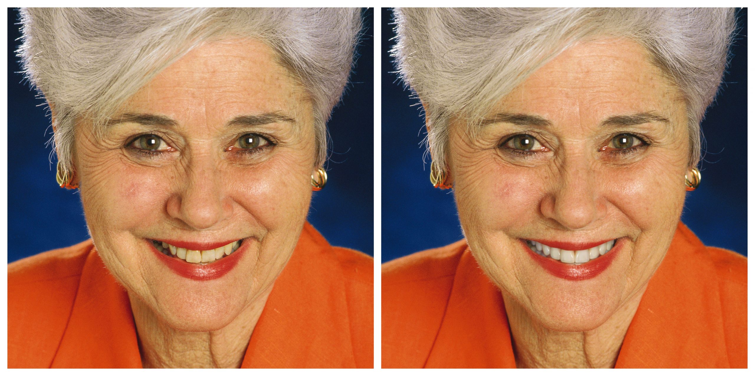 Smile Restoration - Before and After10