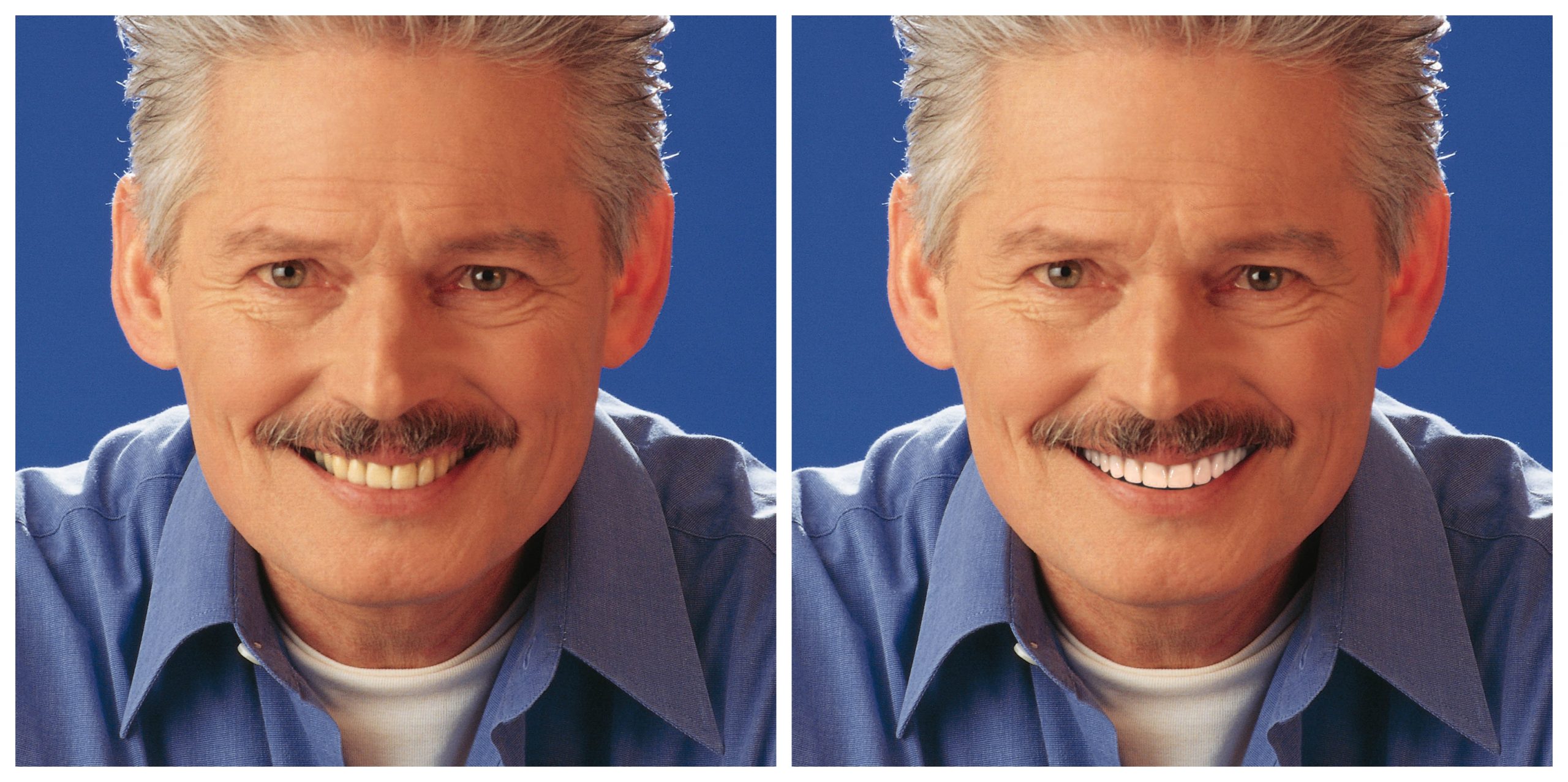 Smile Restoration - Before and After13