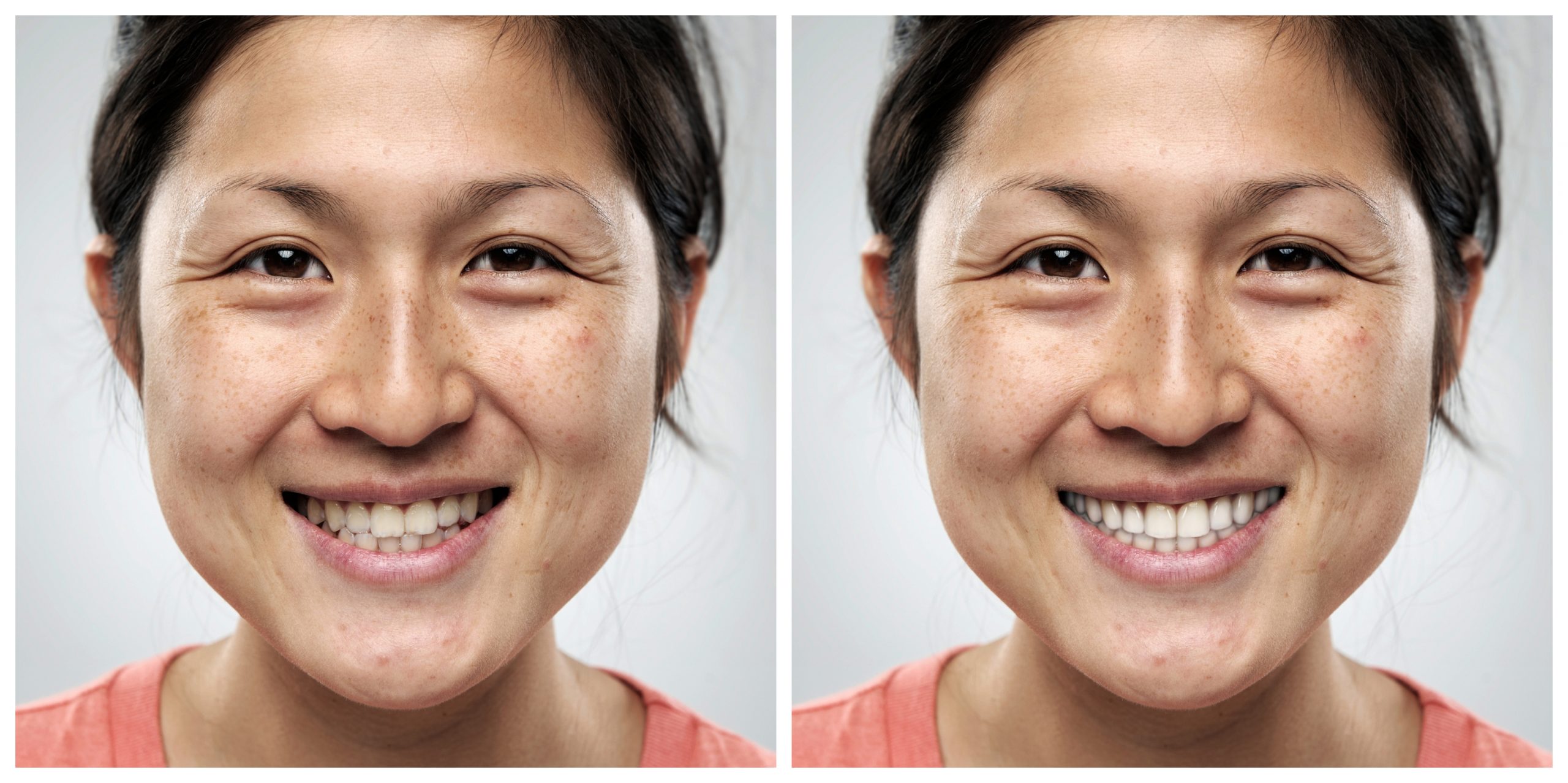 Smile Restoration - Before and After16