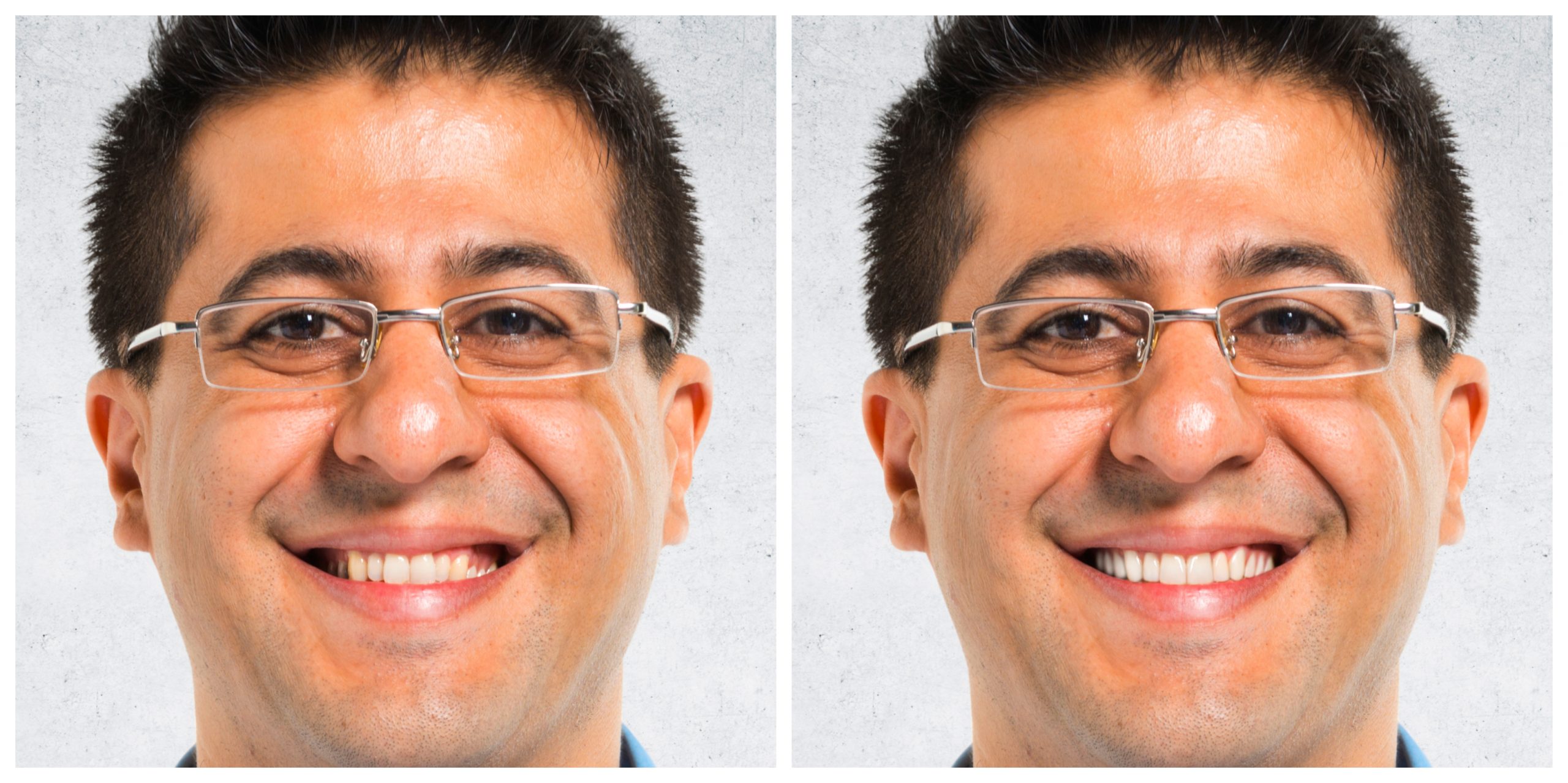 Smile Restoration - Before and After18