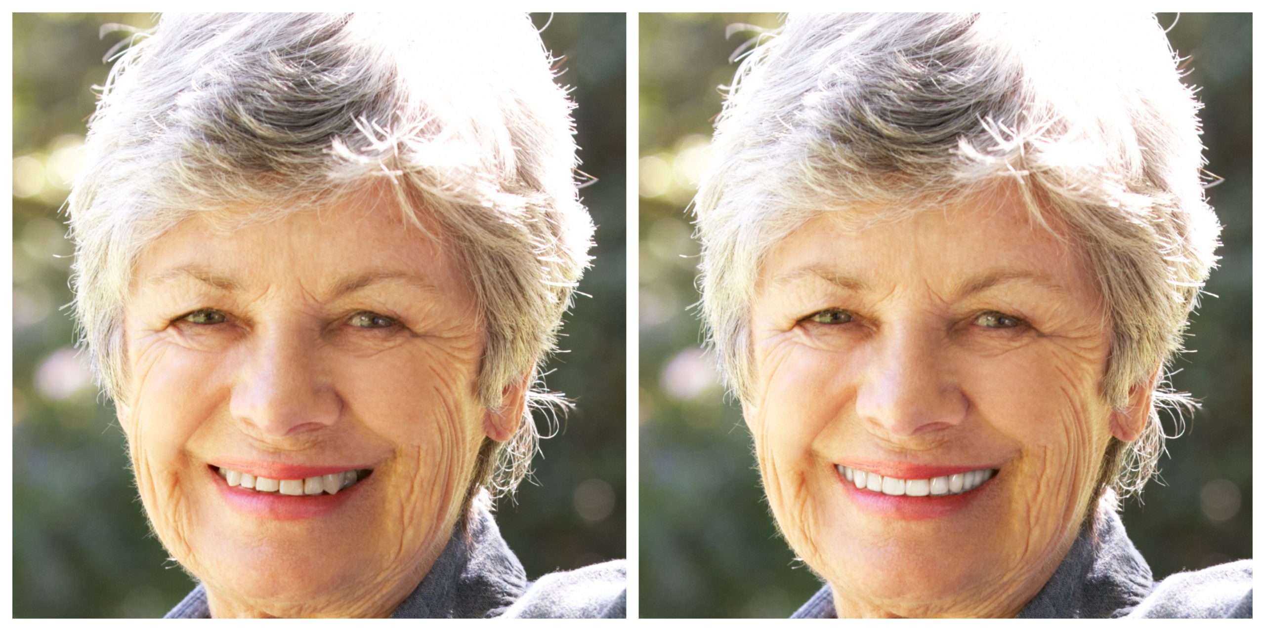 Smile Restoration - Before and After2