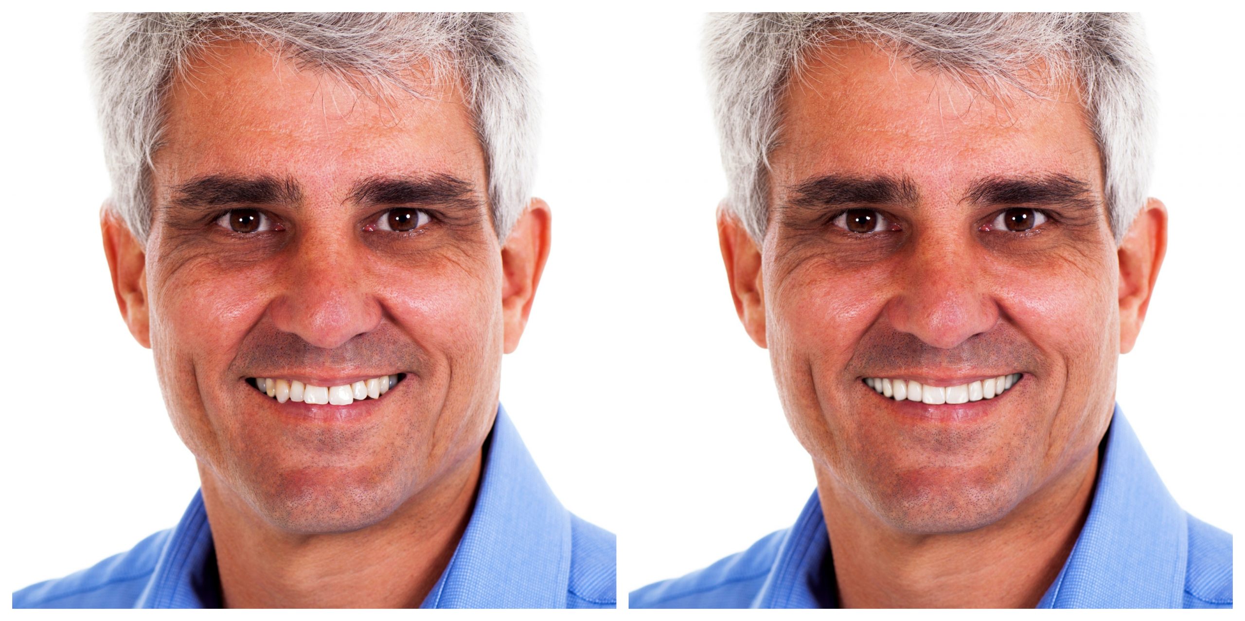 Smile Restoration - Before and After20