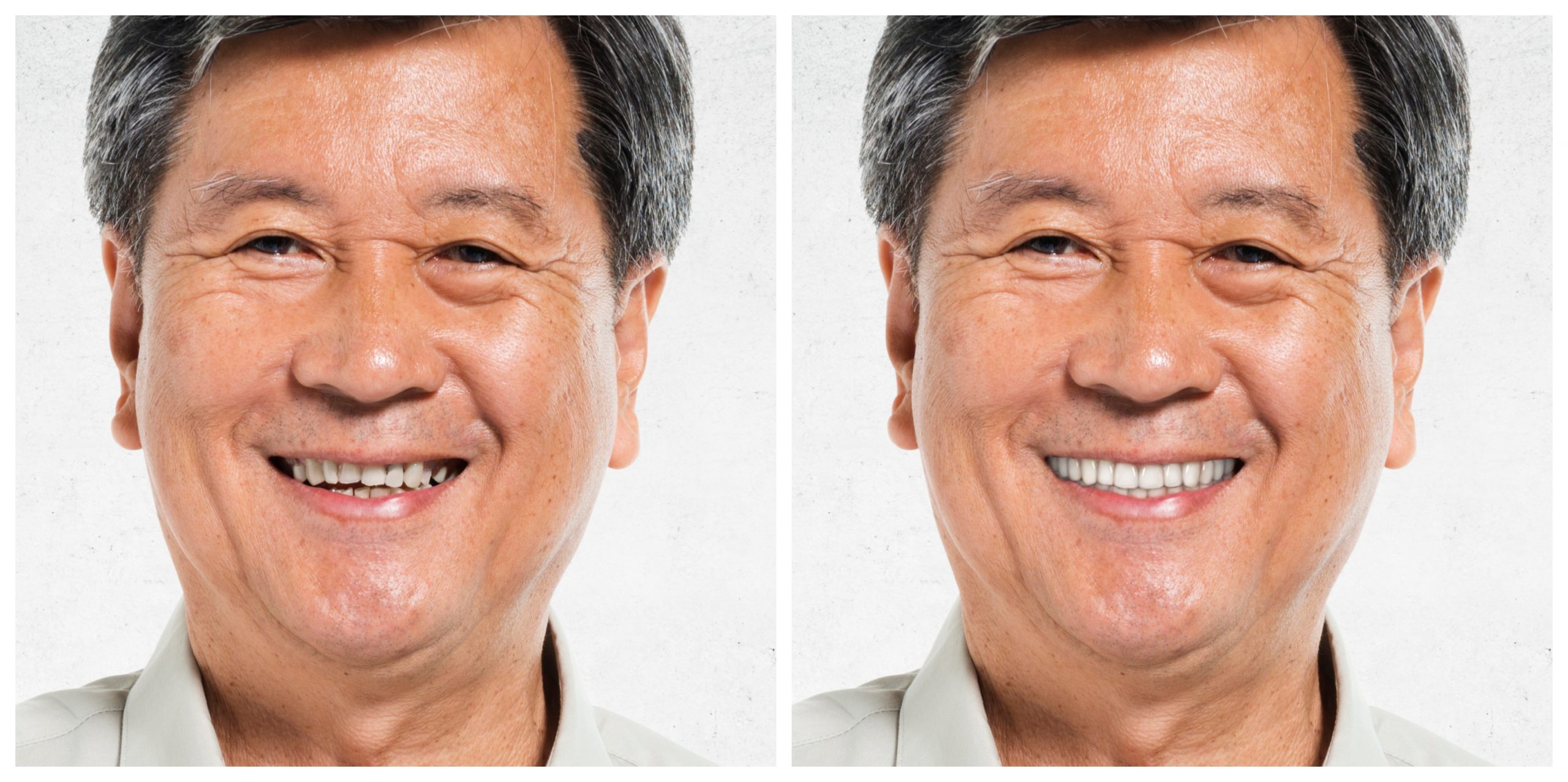 Smile Restoration - Before and After21
