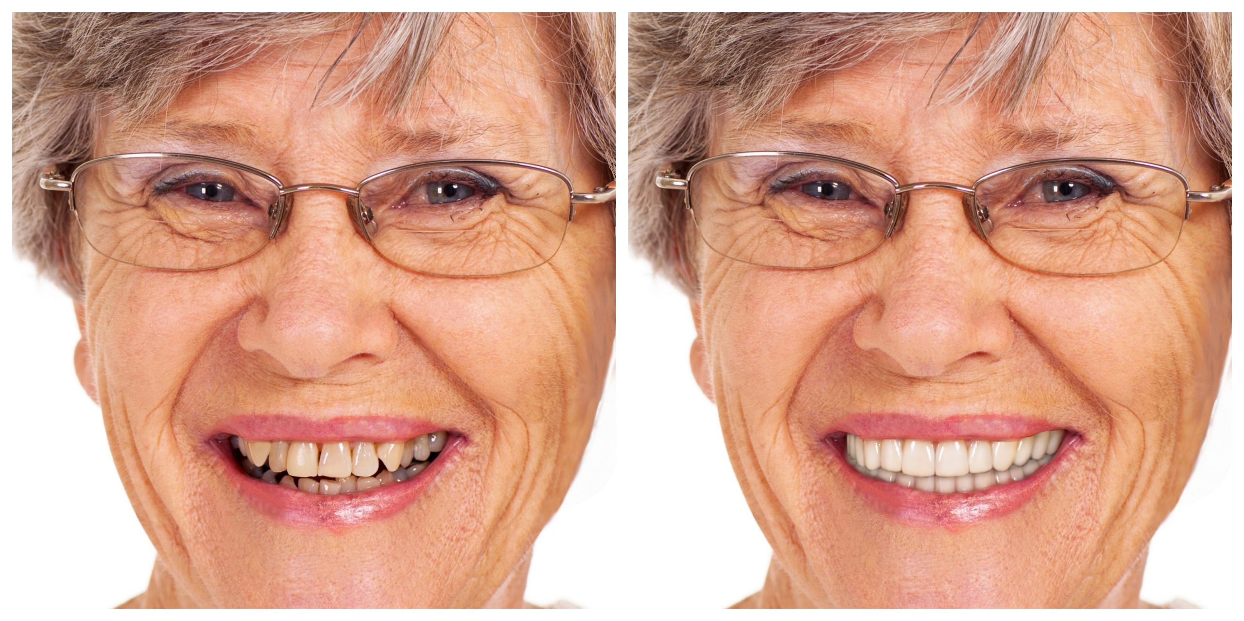 Smile Restoration - Before and After22