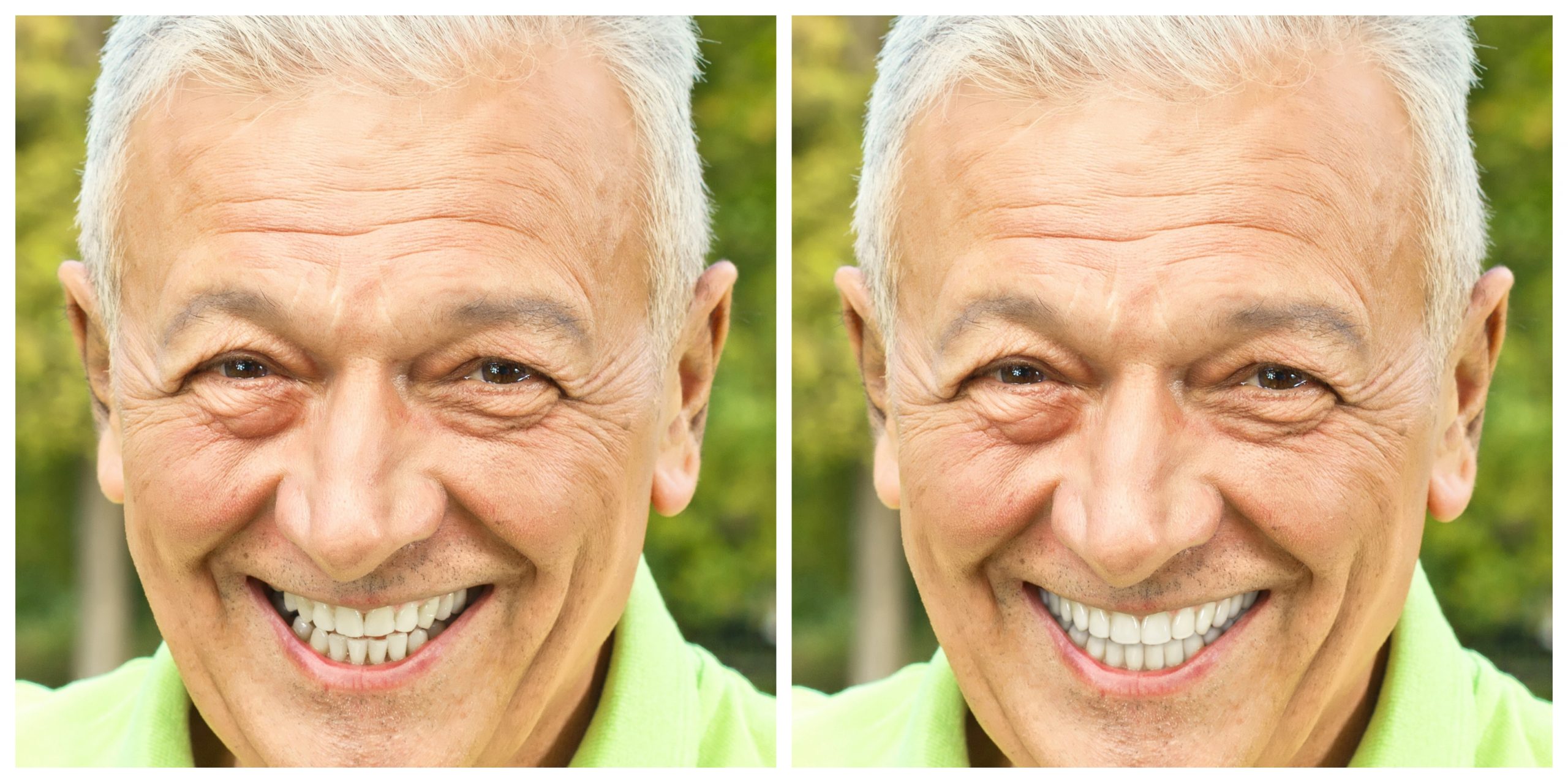 Smile Restoration - Before and After24