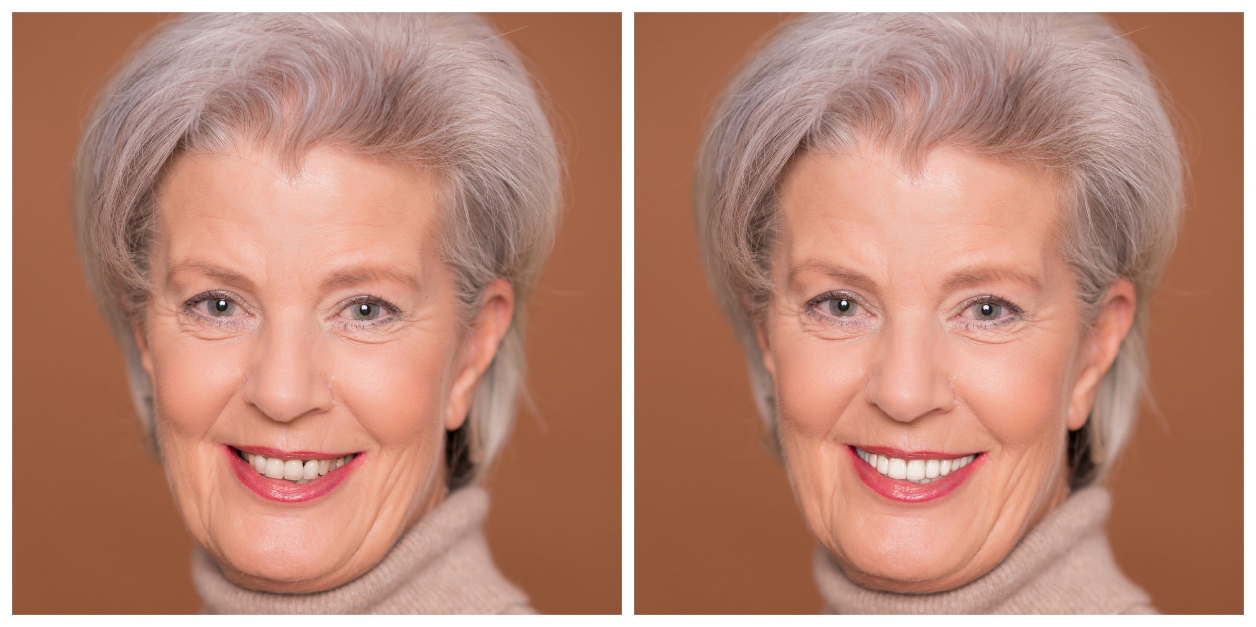 Smile Restoration - Before and After26