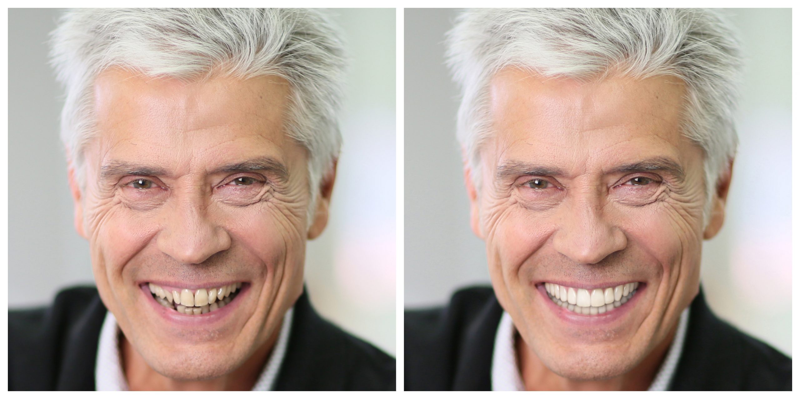 Smile Restoration - Before and After27