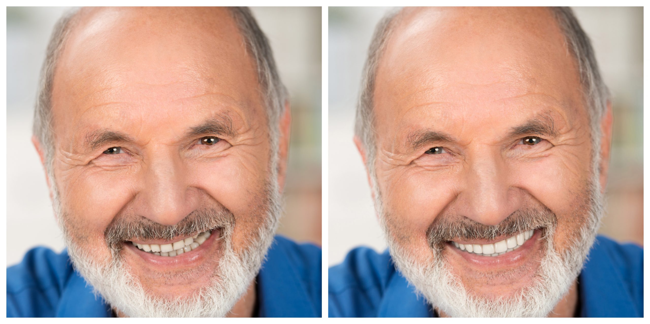 Smile Restoration - Before and After3