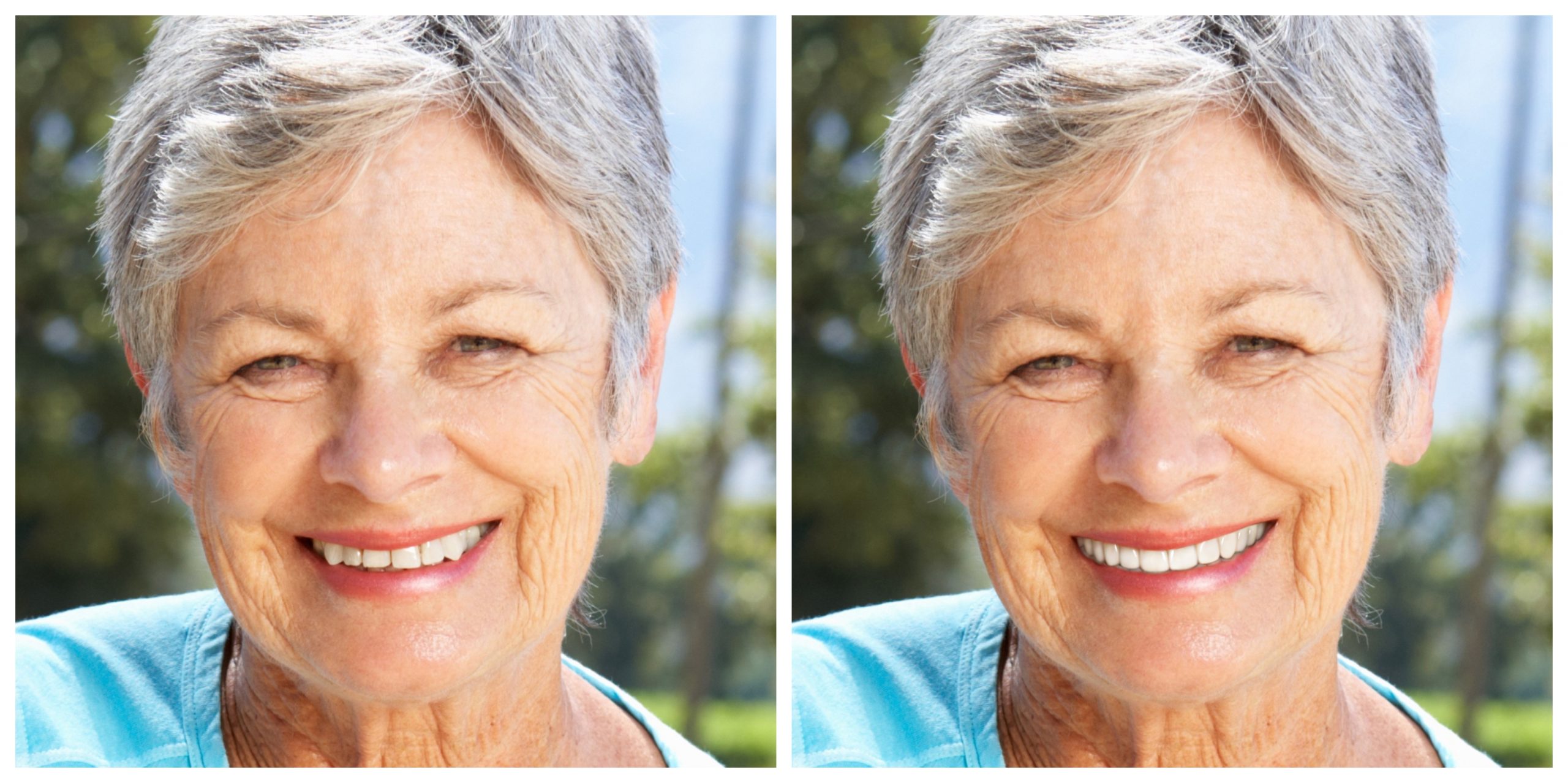 Smile Restoration - Before and After33