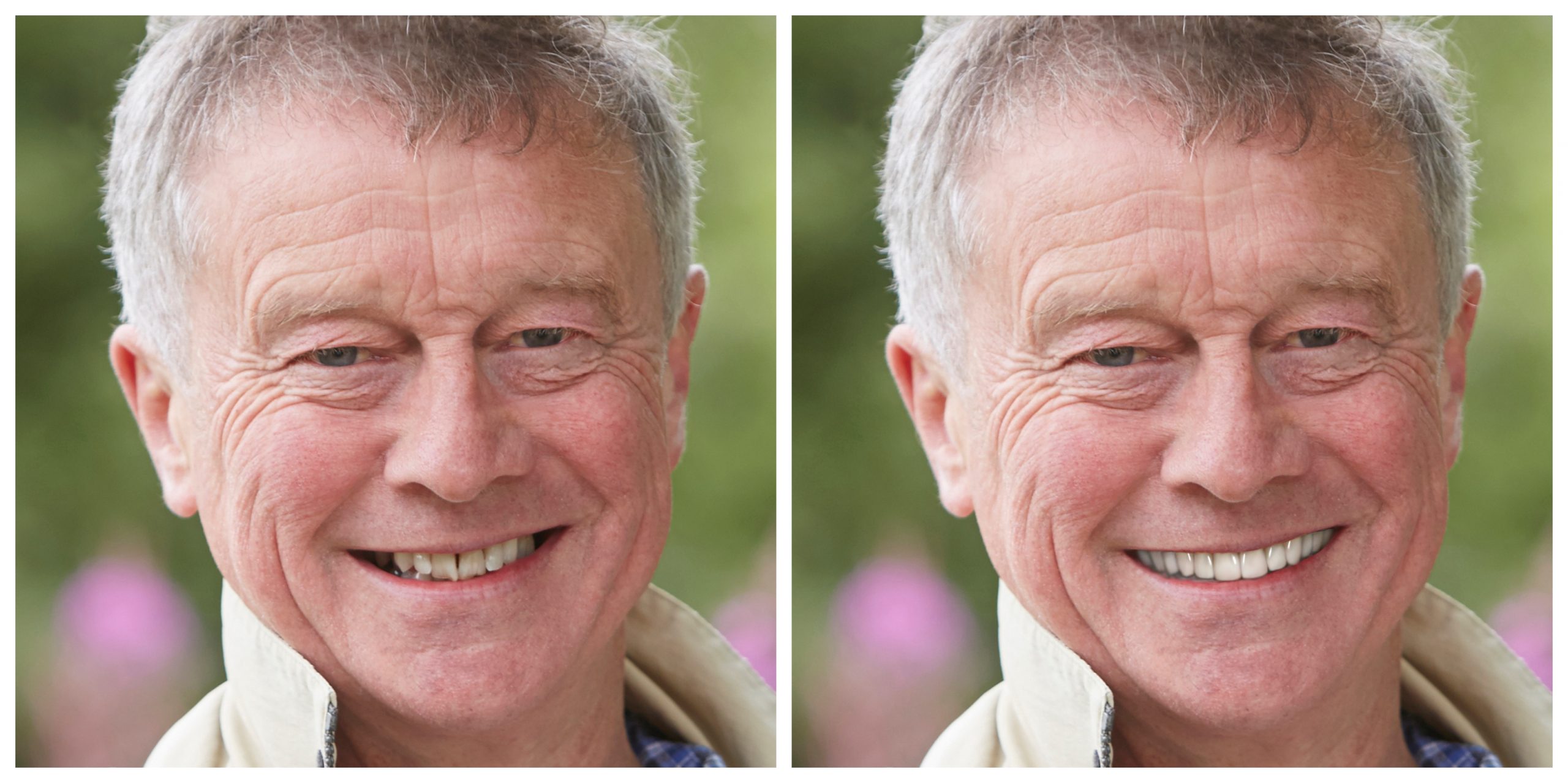 Smile Restoration - Before and After34