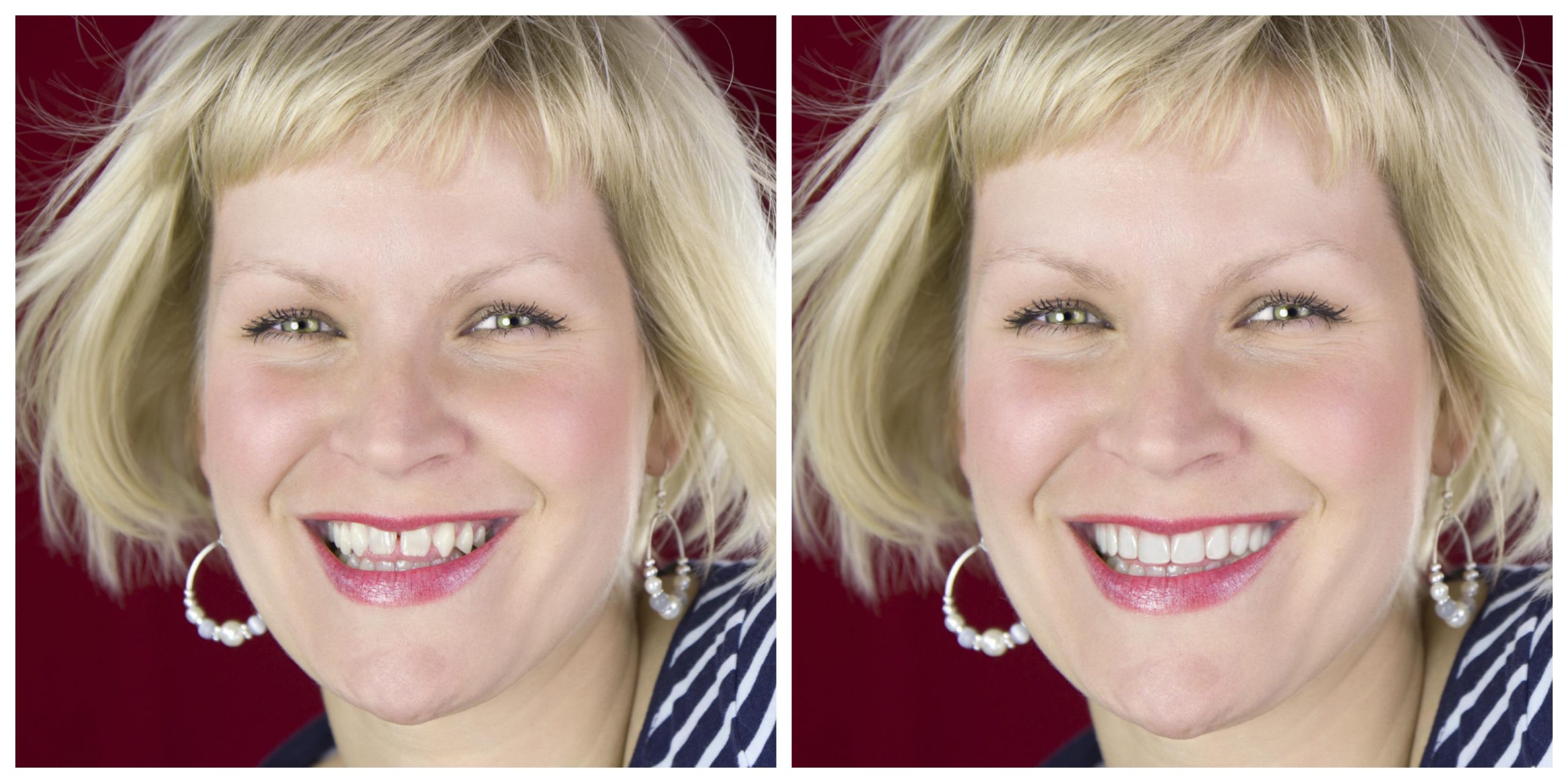 Smile Restoration - Before and After5