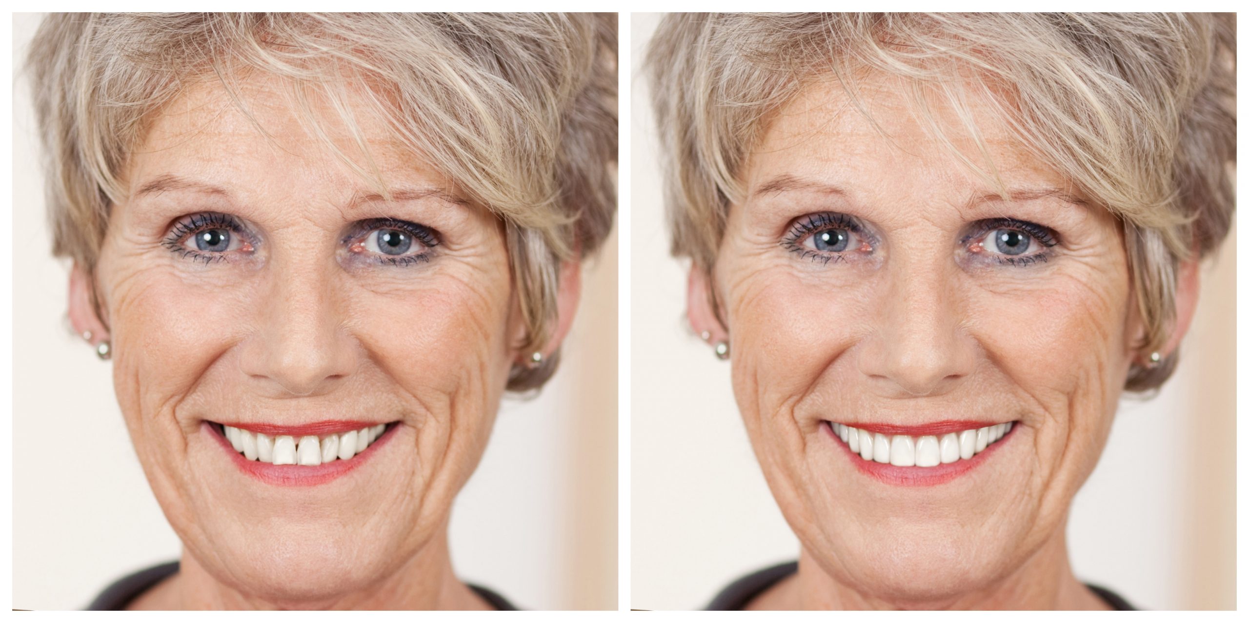 Smile Restoration - Before and After6