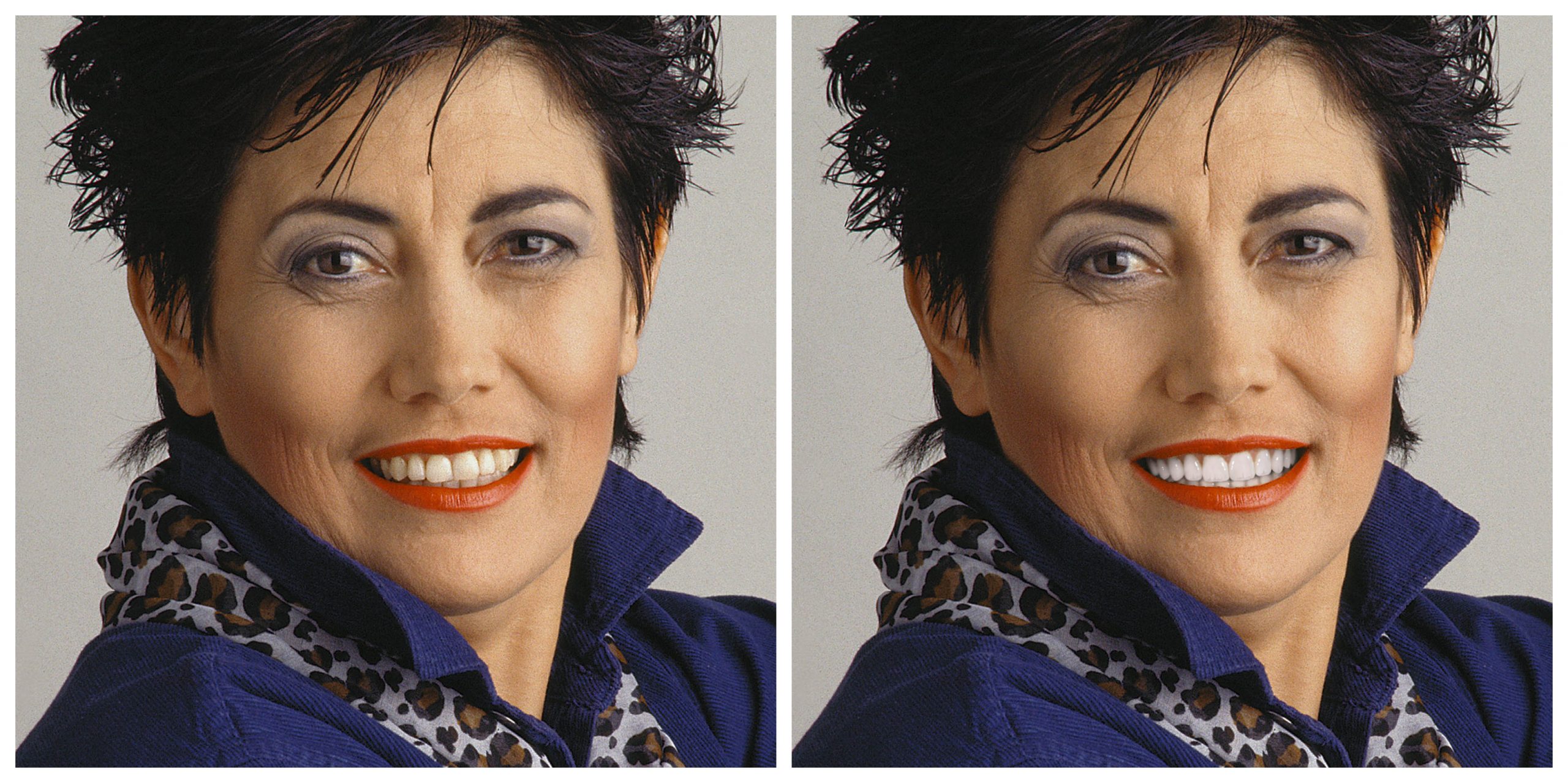 Smile Restoration - Before and After7