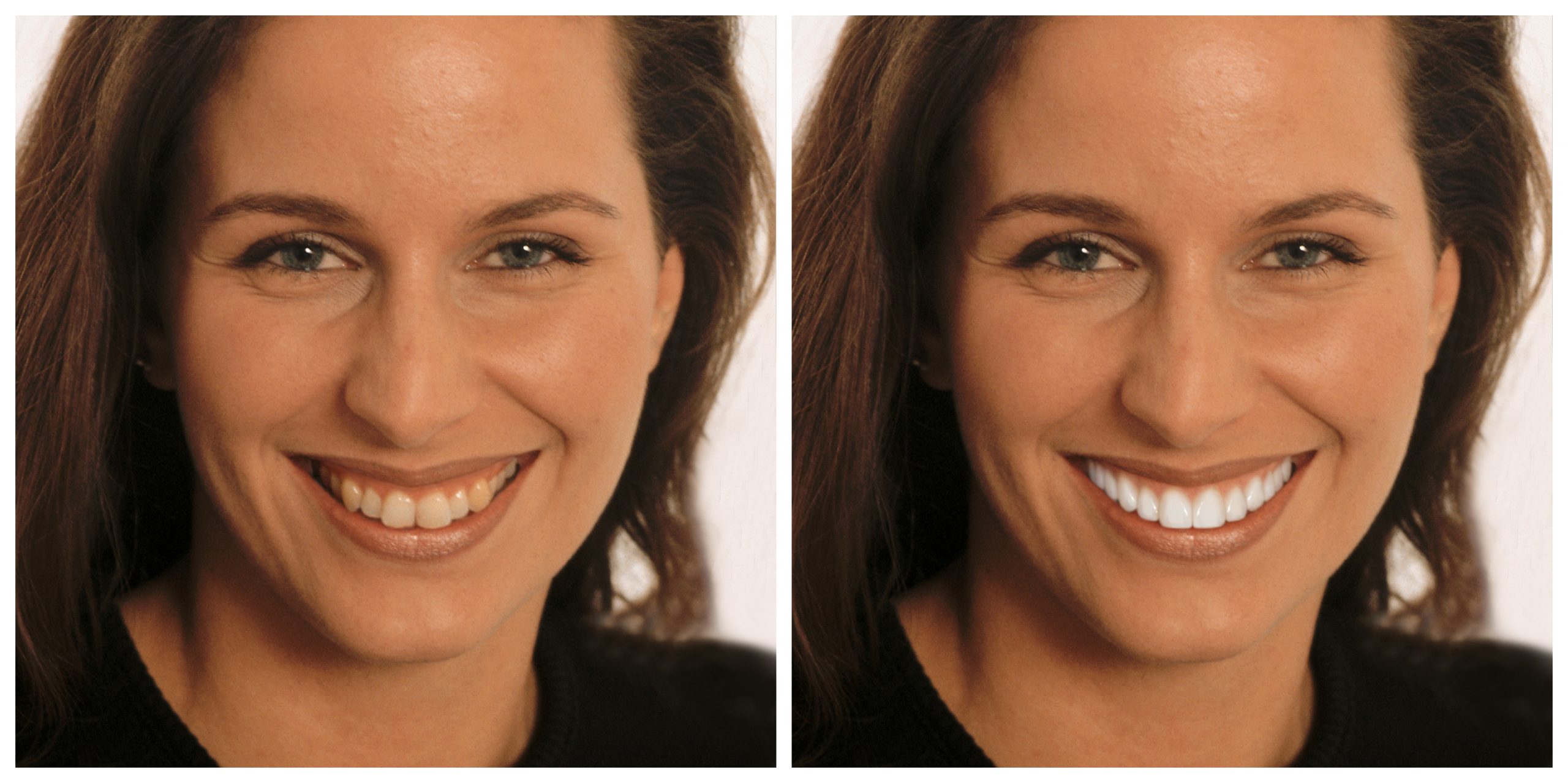 Smile Restoration - Before and After8