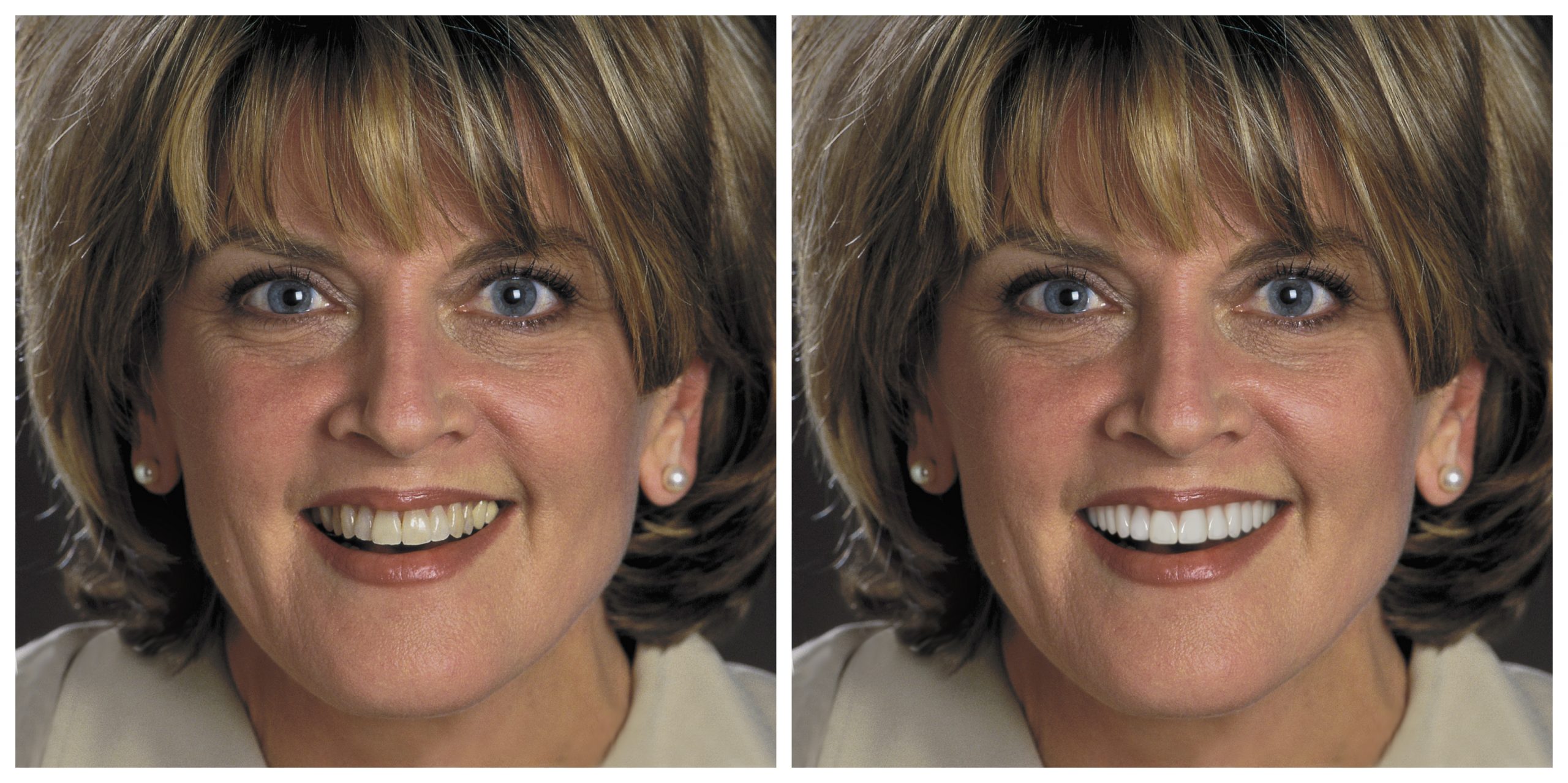 Smile Restoration - Before and After9