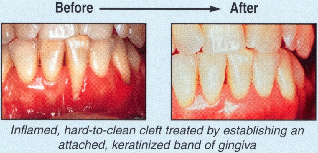 Aesthetic Periodontics - Before and After8
