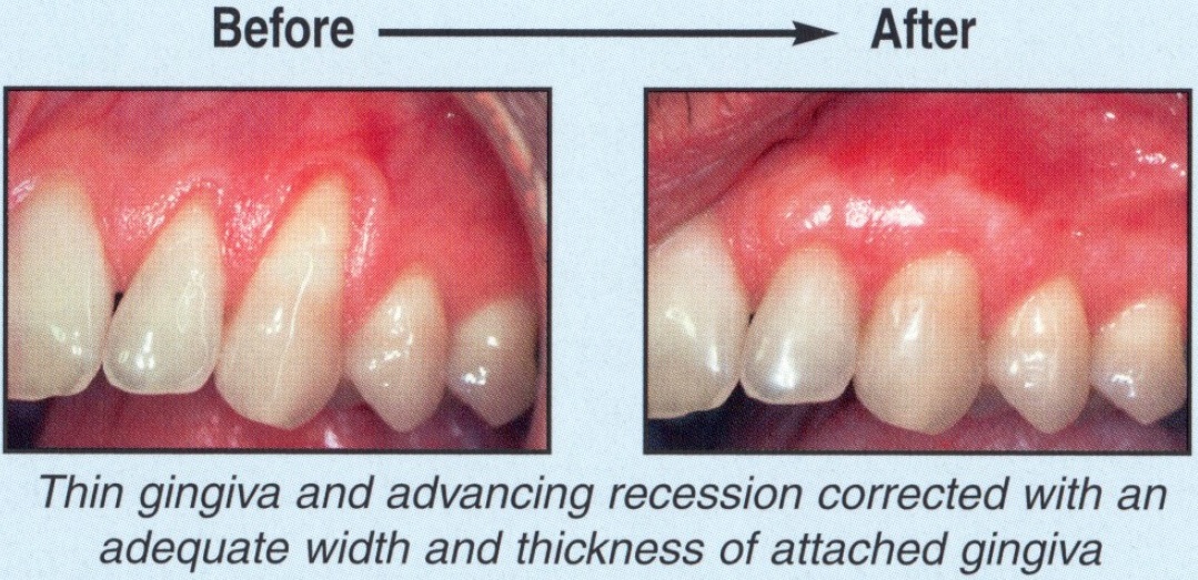 Gum Rejuvenation - Before and After2