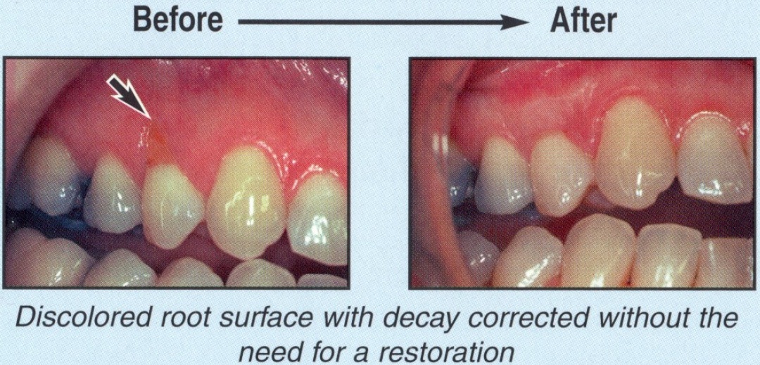 Gum Rejuvenation - Before and After3