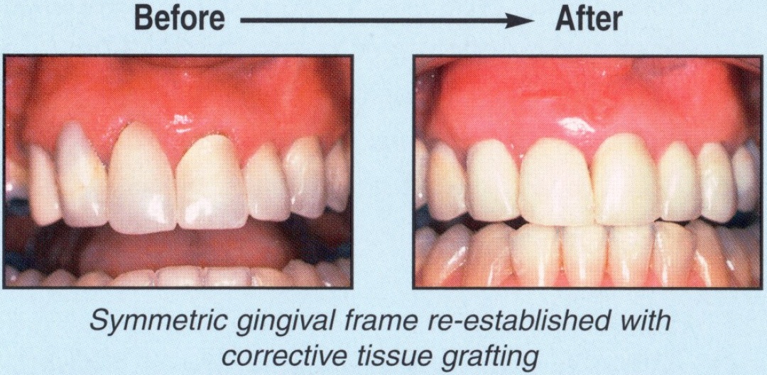 Gum Rejuvenation - Before and After5