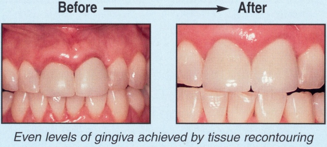 Gum Rejuvenation - Before and After6