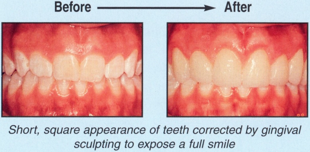 Gum Rejuvenation - Before and After7