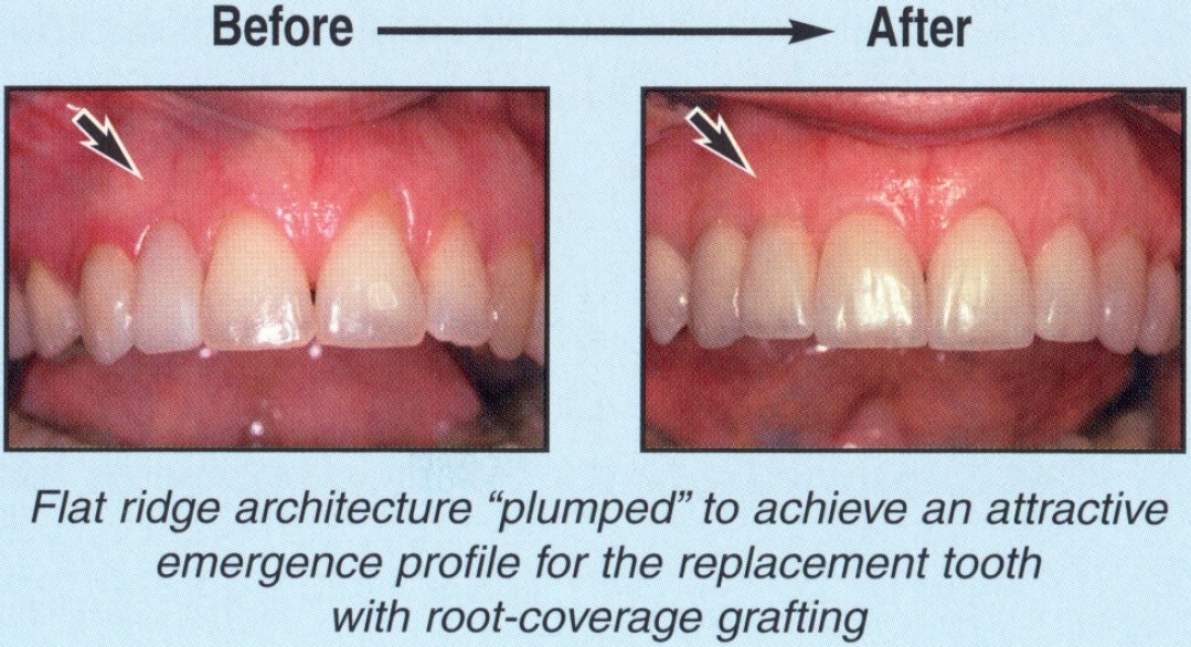 Gum Rejuvenation - Before and After8