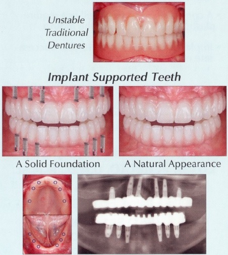 Dental Bridges - Before and After2