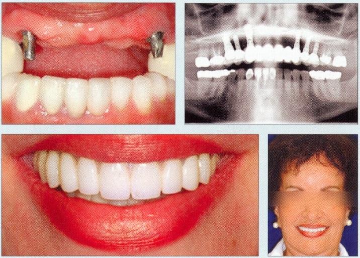 Dental Implants - Before and After1