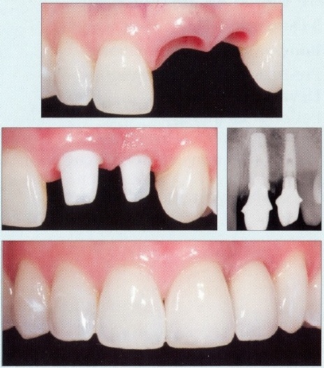 Dental Crowns - Before and After3