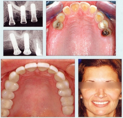Dental Bridges - Before and After1