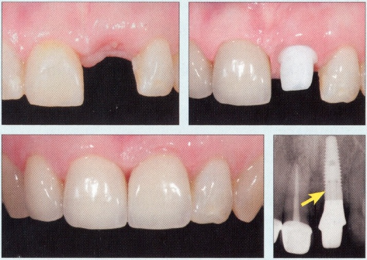 Dental Crowns - Before and After1