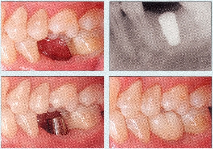 Dental Implants - Before and After2
