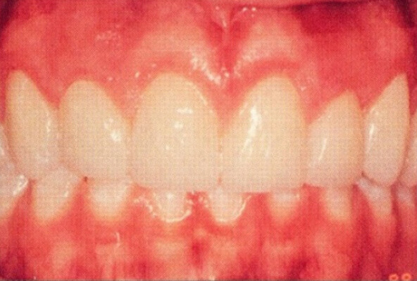 Patient teeth, after Aesthetic Periodontics treatment, front view patient 1