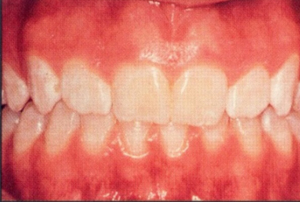 Patient teeth, before Aesthetic Periodontics treatment, front view patient 1