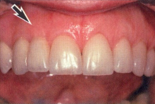 Patient teeth, after Aesthetic Periodontics treatment, front view patient 2