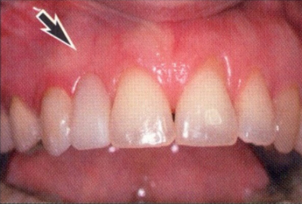 Patient teeth, before Aesthetic Periodontics treatment, front view patient 2