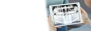 Bone reconstruction photo