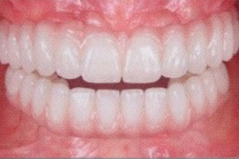 Complete Set of Implant-Supported Teeth, after treatment photo, patient 2