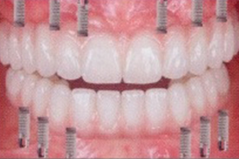 Complete Set of Implant-Supported Teeth, before treatment photo, patient 2