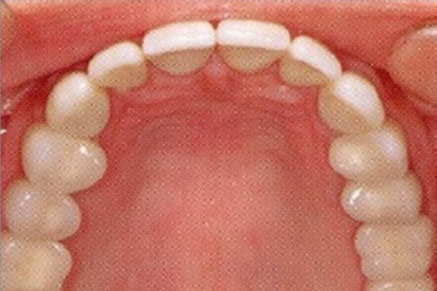 Posterior Teeth Replaced with Implants, after treatment photo, patient 1