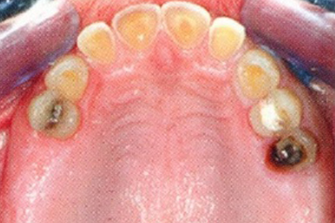 Posterior Teeth Replaced with Implants, before treatment photo, patient 1
