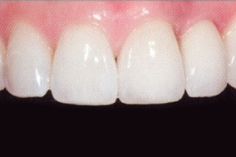 Multiple Tooth Replacement, after treatment photo, patient 1