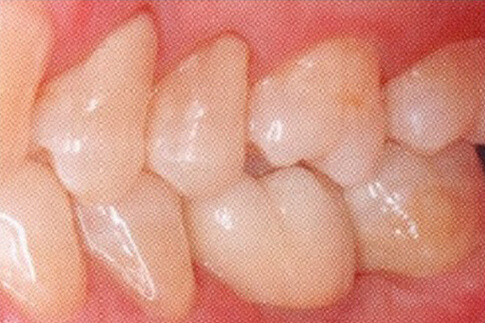 Single Molar Replacement, after treatment photo, patient 2