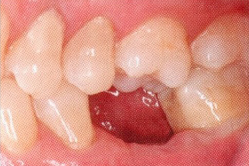 Single Molar Replacement, before treatment photo, patient 2