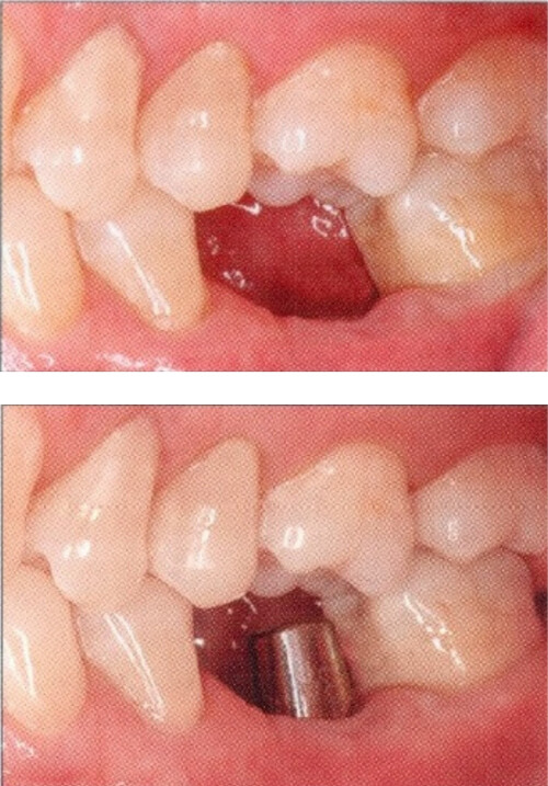 Patient teeth, before and after Dental Implants treatment, step 1