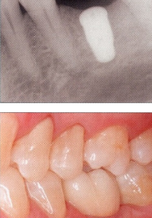 Patient teeth, before and after Dental Implants treatment, step 2