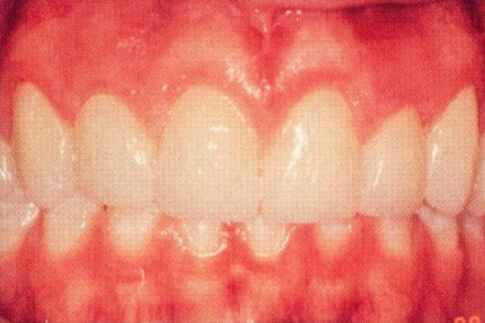 Patient teeth, after Gum Rejuvenation treatment, front view, patient 1 